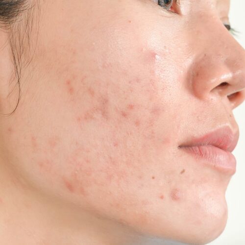 Acne-prone skin