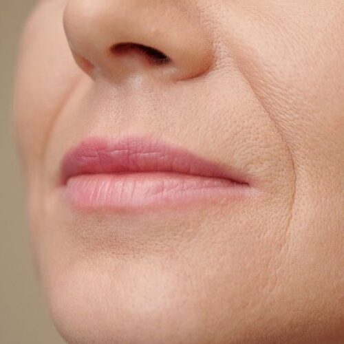 Aging skin