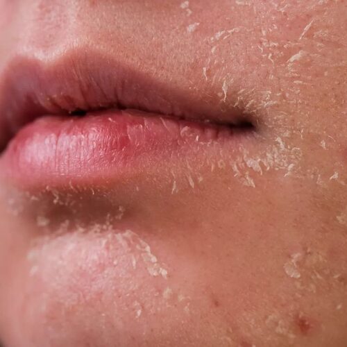 Dry & flaky skin