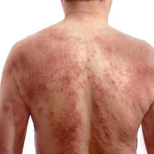 Eczema