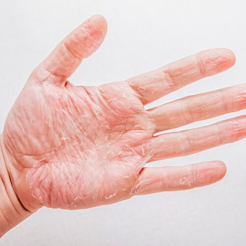 Hand Eczema