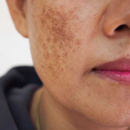 Pigmentation