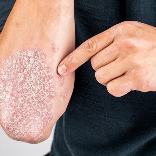 Psoriasis