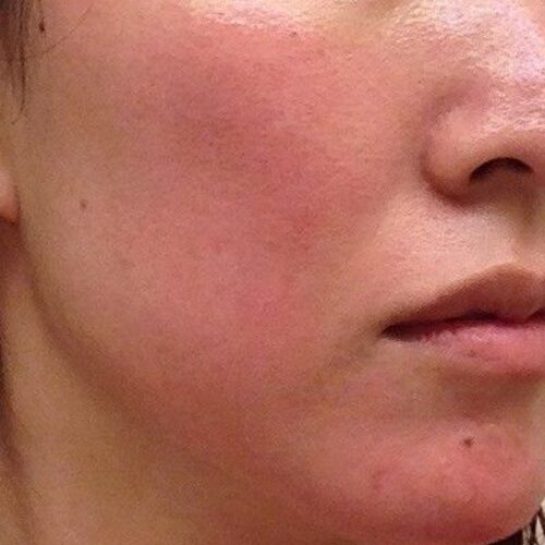 Sensitive skin