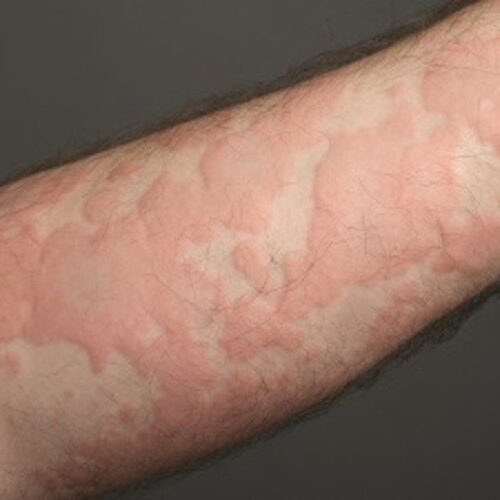 Urticaria